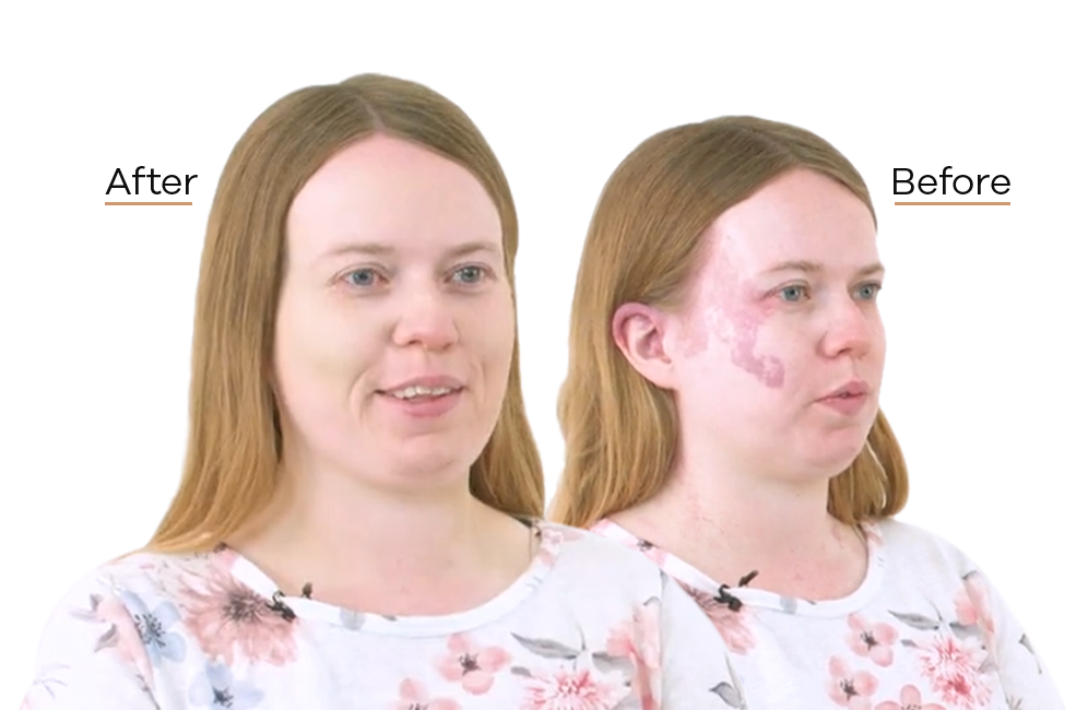Microskin before-and-after comparison 1; after on the left, before on the right